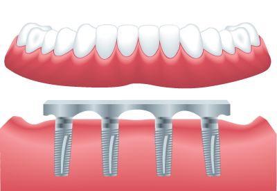 Implant Supported Dentures in Cincinnati, OH
