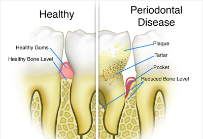 Gum Disease and Tooth and Bone Loss Cincinnati, OH